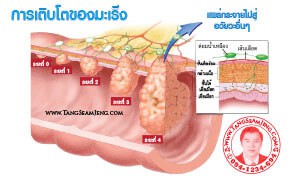 โรคมะเร็ง