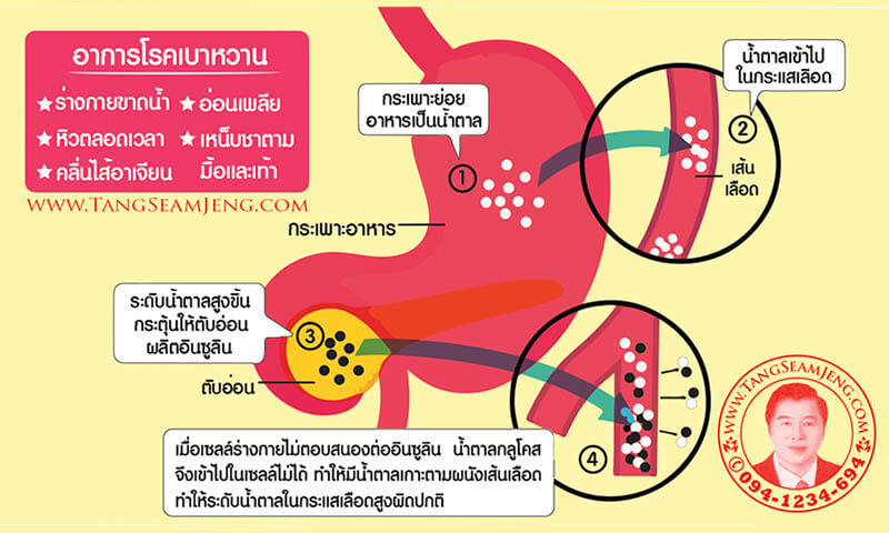 การรักษาโรคเบาหวานด้วยแพทย์แผนจีน