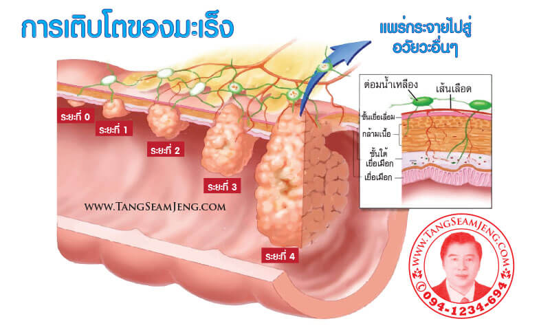 โรคมะเร็ง