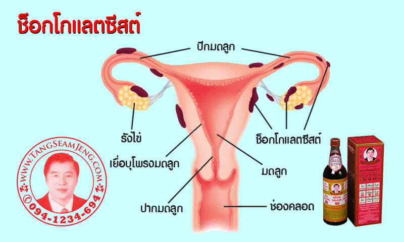 ช็อกโกแลตซีสต์