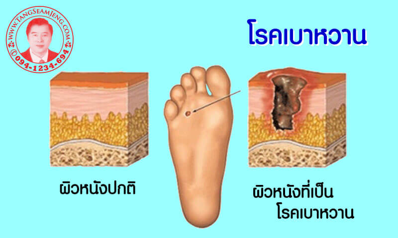 โรคเบาหวาน